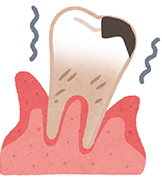 歯周病と虫歯