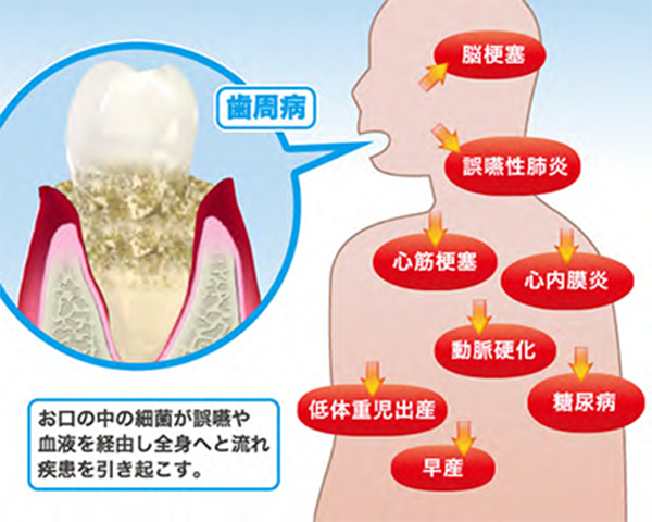 お口の中の最近が誤嚥や血液を経由し全身へと流れ疾患を引き起こす。