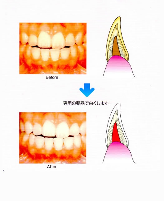 歯のホワイトニング