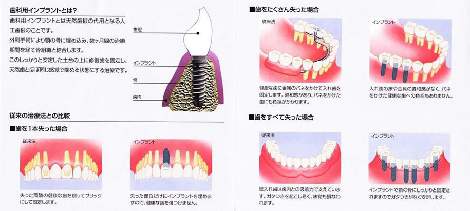 インプラント図